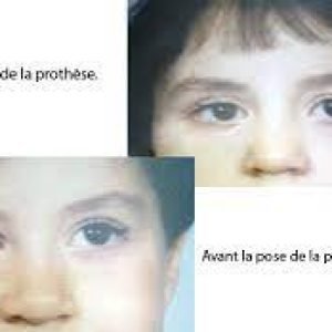 Sondage: L’oculariste est un métier en pleine expansion  au Maroc
